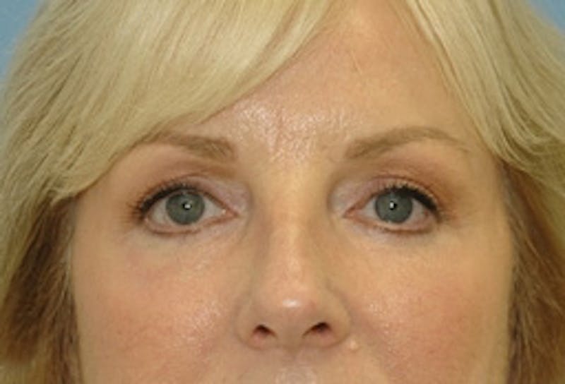 Brow Lift Before & After Gallery - Patient 169544 - Image 2