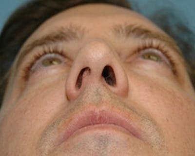 Rhinoplasty Before & After Gallery - Patient 280180 - Image 1