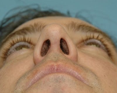 Rhinoplasty Before & After Gallery - Patient 280180 - Image 2