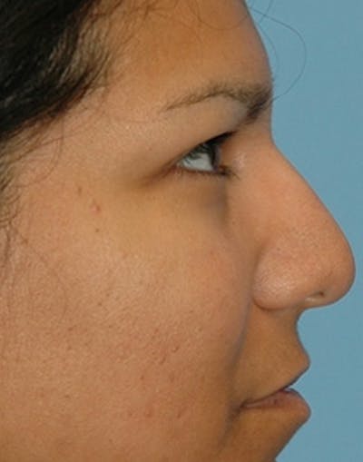 Rhinoplasty Before & After Gallery - Patient 360654 - Image 1
