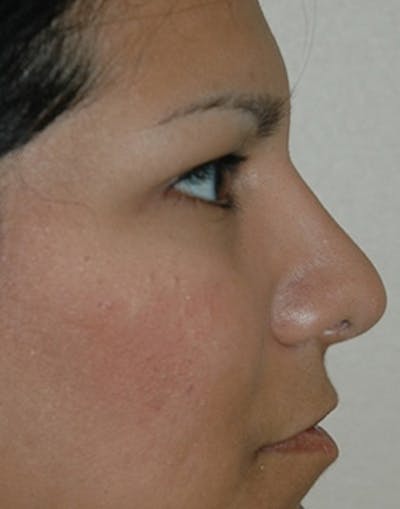 Rhinoplasty Before & After Gallery - Patient 360654 - Image 2