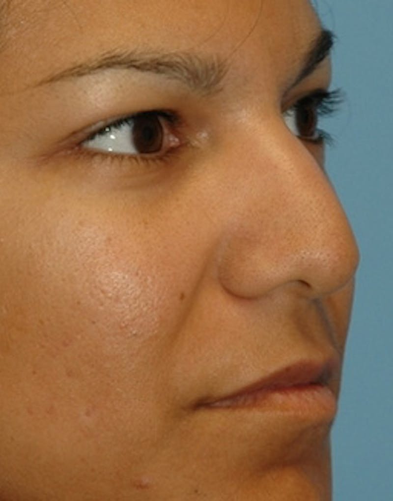 Rhinoplasty Before & After Gallery - Patient 360654 - Image 3
