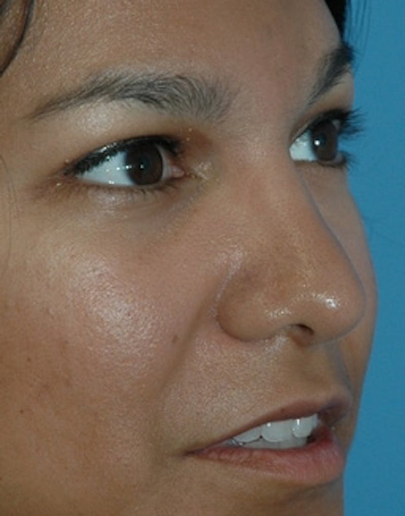 Rhinoplasty Before & After Gallery - Patient 360654 - Image 4
