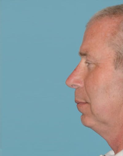 Rhinoplasty Before & After Gallery - Patient 235739 - Image 2