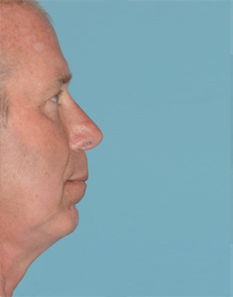 Rhinoplasty Before & After Gallery - Patient 235739 - Image 4