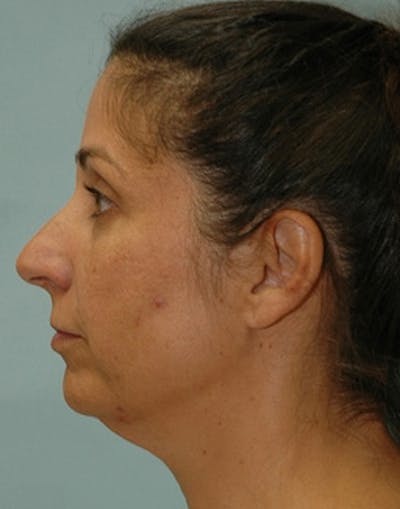 Rhinoplasty Before & After Gallery - Patient 894447 - Image 1