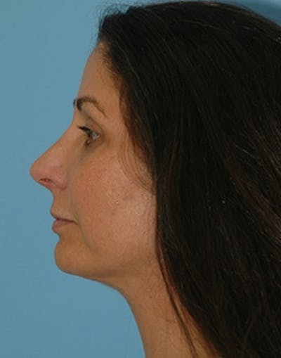 Rhinoplasty Before & After Gallery - Patient 894447 - Image 2