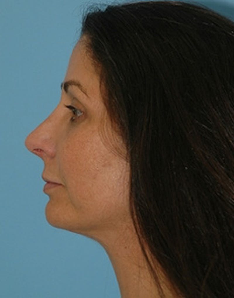 Rhinoplasty Before & After Gallery - Patient 894447 - Image 2