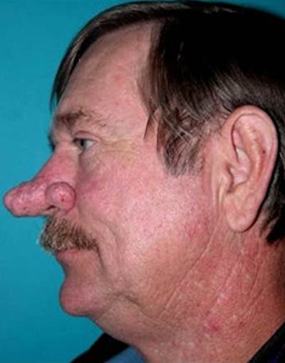 Rhinoplasty Before & After Gallery - Patient 158308 - Image 1