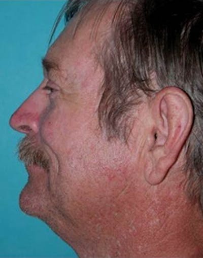 Rhinoplasty Before & After Gallery - Patient 158308 - Image 2