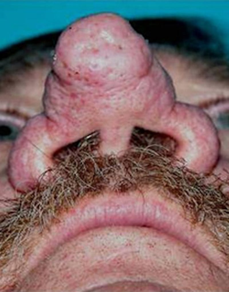 Rhinoplasty Before & After Gallery - Patient 158308 - Image 3