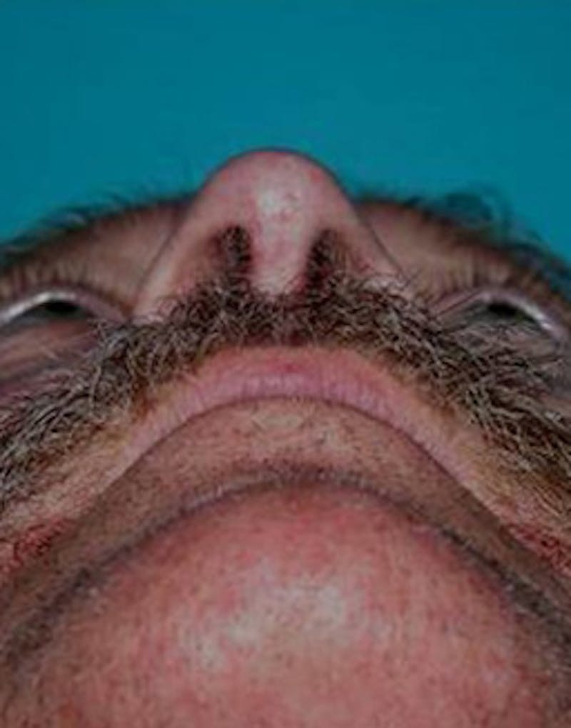 Rhinoplasty Before & After Gallery - Patient 158308 - Image 4