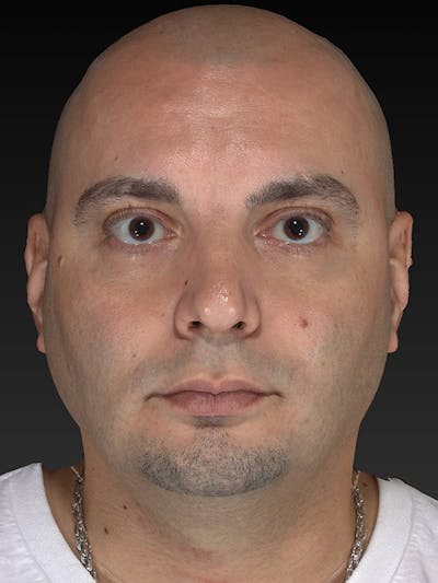 Facial Implants Before & After Gallery - Patient 320406 - Image 1