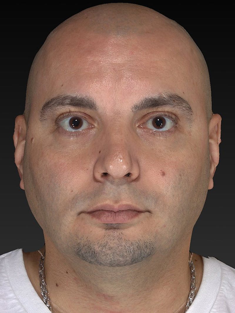 Facial Implants Before & After Gallery - Patient 320406 - Image 1