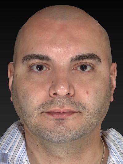 Facial Implants Before & After Gallery - Patient 320406 - Image 2