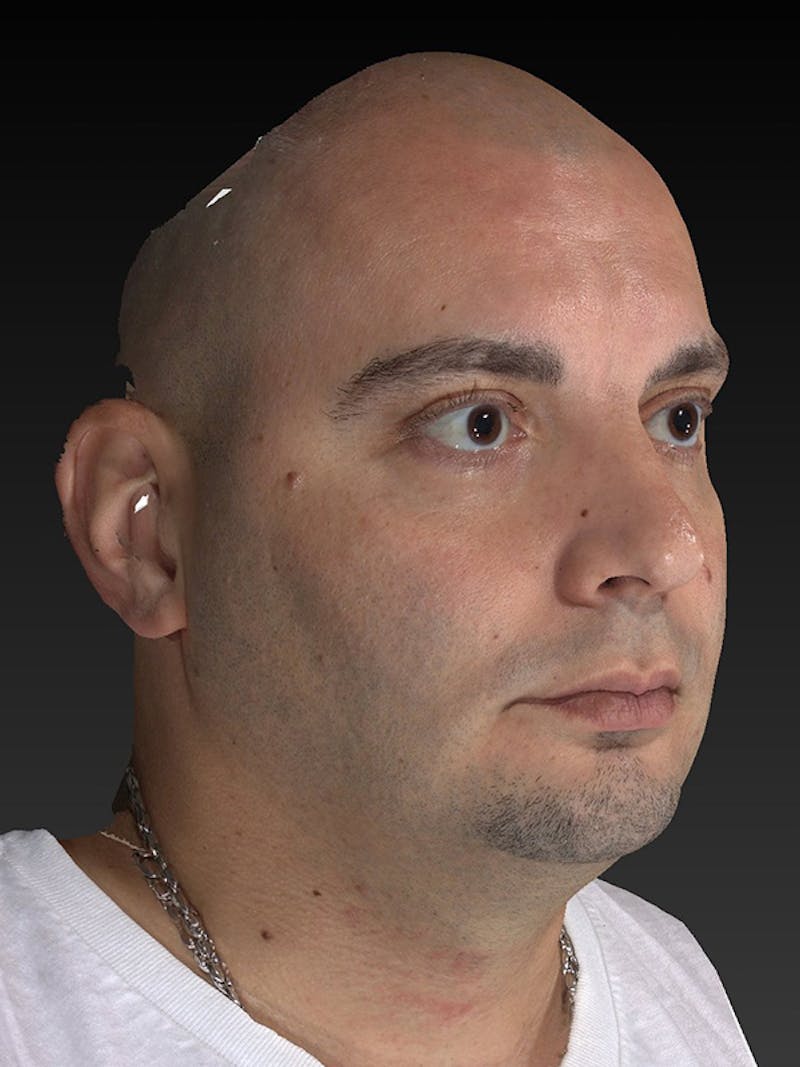 Facial Implants Before & After Gallery - Patient 320406 - Image 3
