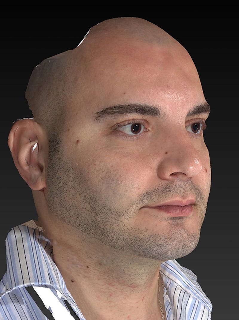Facial Implants Before & After Gallery - Patient 320406 - Image 4