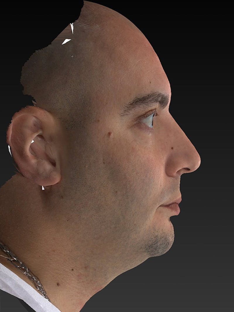 Facial Implants Before & After Gallery - Patient 320406 - Image 5