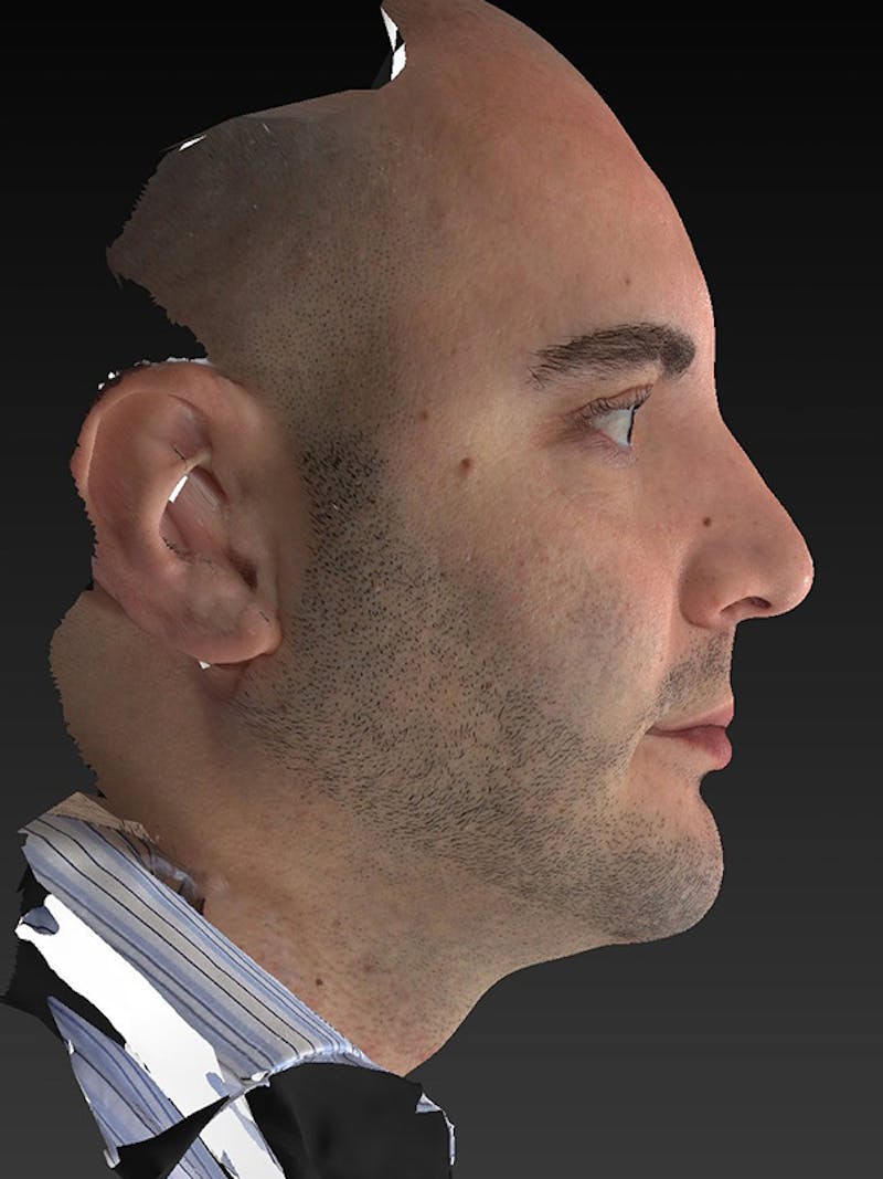 Facial Implants Before & After Gallery - Patient 320406 - Image 6