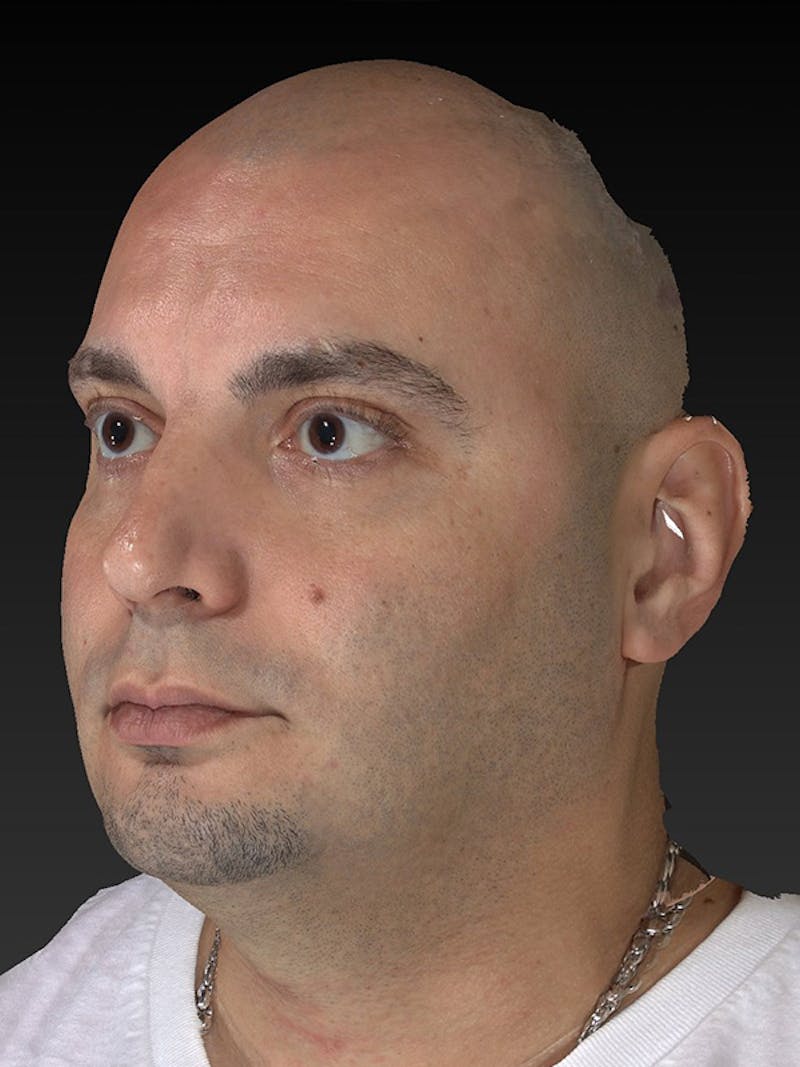 Facial Implants Before & After Gallery - Patient 320406 - Image 7
