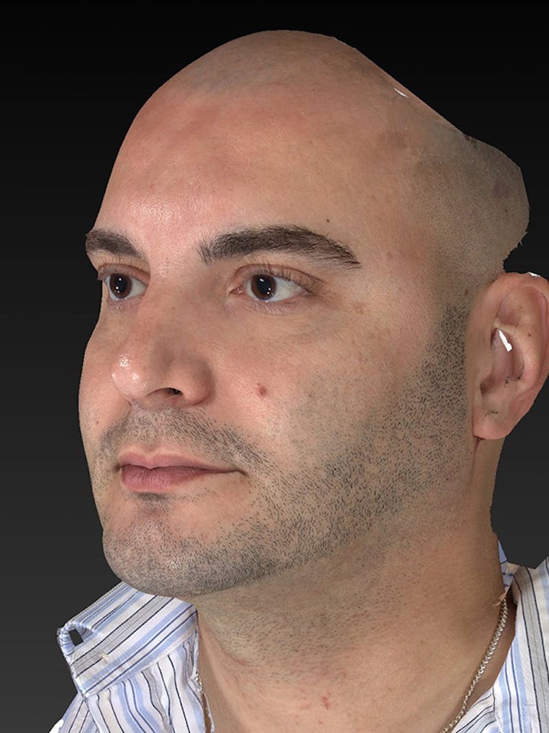 Facial Implants Before & After Gallery - Patient 320406 - Image 8