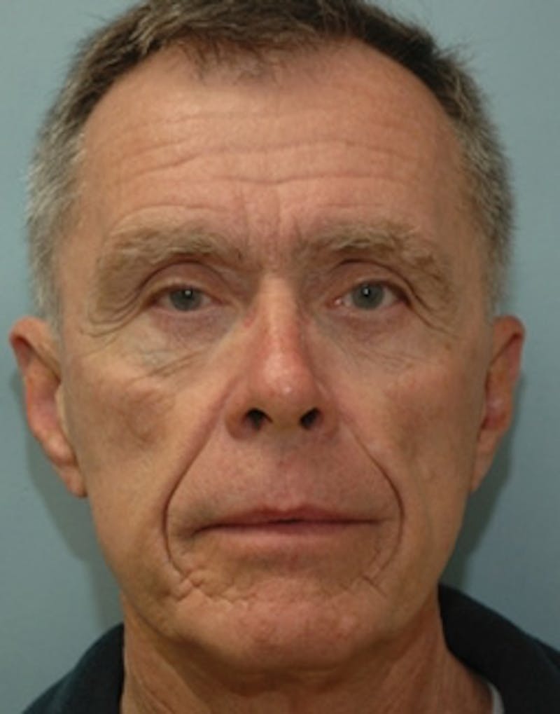 Facial Implants Before & After Gallery - Patient 366924 - Image 1