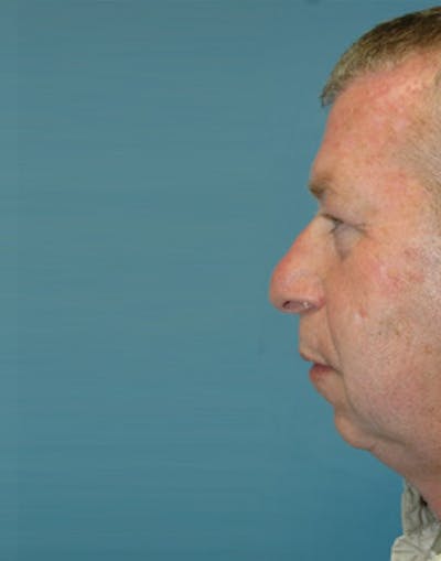Facial Implants Before & After Gallery - Patient 272710 - Image 1