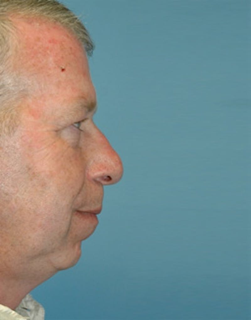 Facial Implants Before & After Gallery - Patient 272710 - Image 3