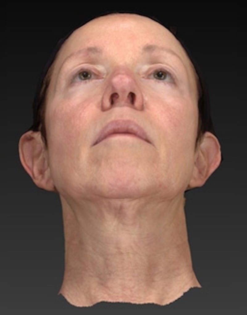 Facial Implants Before & After Gallery - Patient 168992 - Image 9