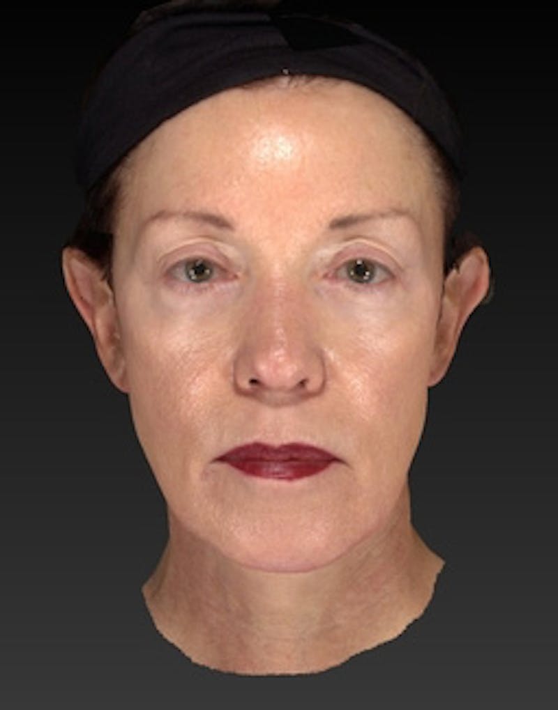 Facial Implants Before & After Gallery - Patient 168992 - Image 12