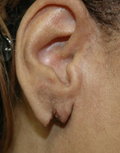 Ear Surgery Before & After Gallery - Patient 424489 - Image 1