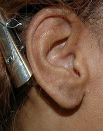 Ear Surgery Before & After Gallery - Patient 424489 - Image 2