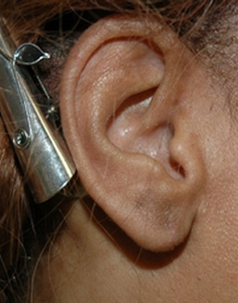 Ear Surgery Before & After Gallery - Patient 424489 - Image 2