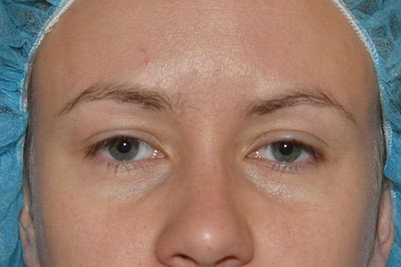 Ptosis Treatment Before & After Gallery - Patient 232344 - Image 1