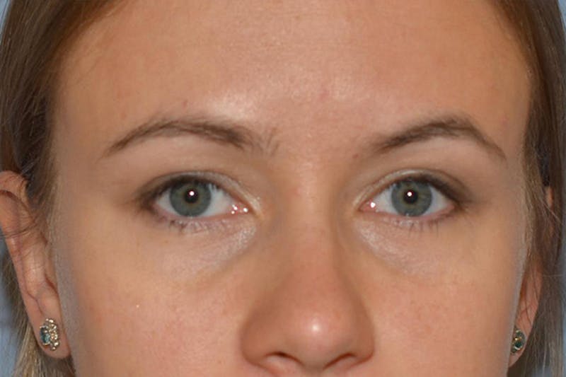 Ptosis Treatment Before & After Gallery - Patient 232344 - Image 2