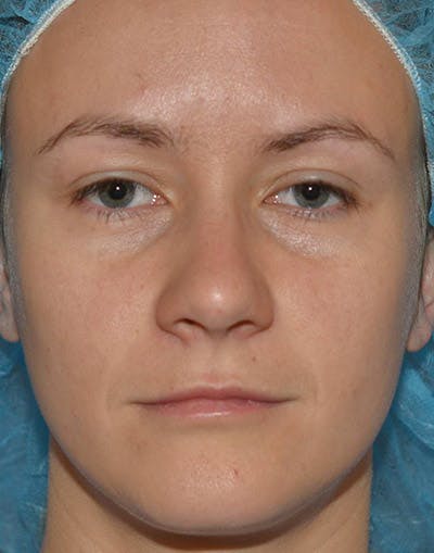 Ptosis Treatment Before & After Gallery - Patient 110215 - Image 1