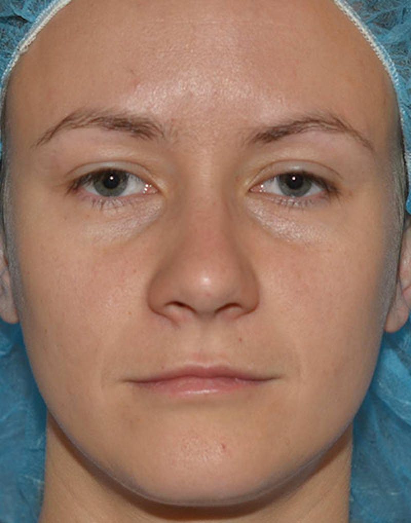Ptosis Treatment Before & After Gallery - Patient 110215 - Image 1