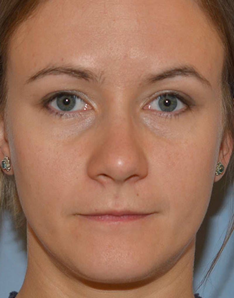 Ptosis Treatment Before & After Gallery - Patient 110215 - Image 2