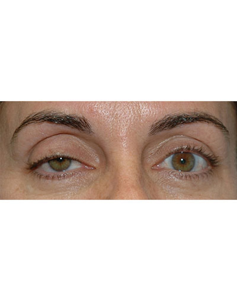 Ptosis Treatment Before & After Gallery - Patient 273452 - Image 1