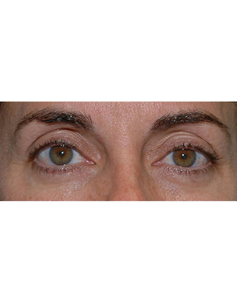 Ptosis Treatment Before & After Gallery - Patient 273452 - Image 2