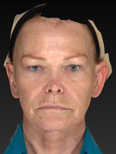 Laser Skin Rejuvenation Before & After Gallery - Patient 123334 - Image 1