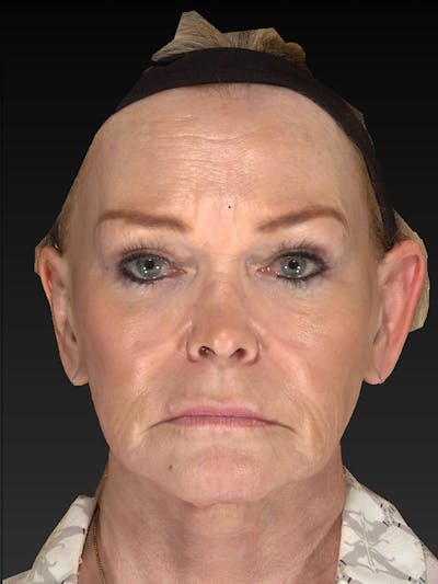 Laser Skin Rejuvenation Before & After Gallery - Patient 123334 - Image 2