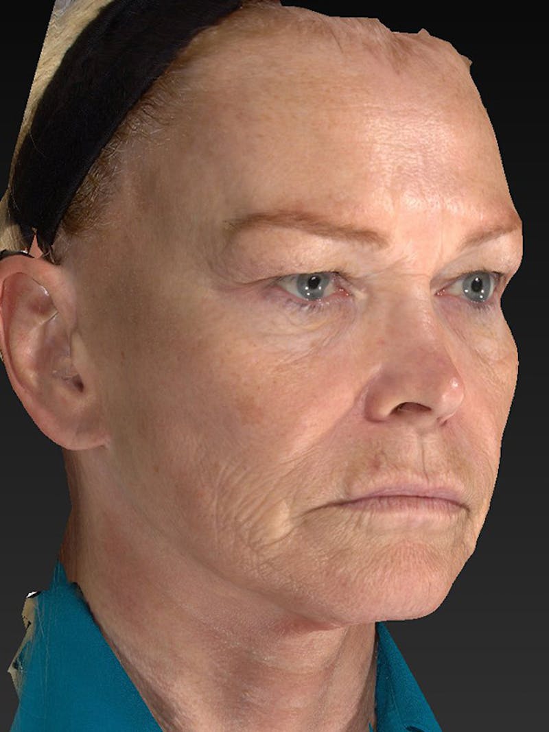 Laser Skin Rejuvenation Before & After Gallery - Patient 123334 - Image 3