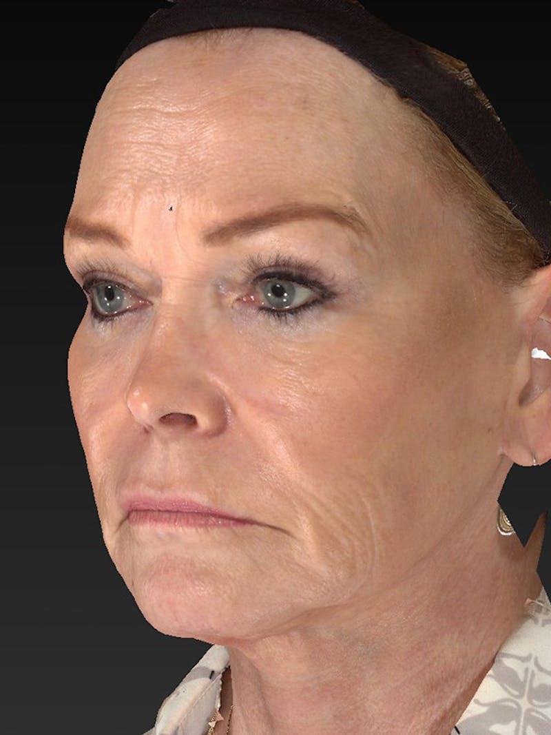 Laser Skin Rejuvenation Before & After Gallery - Patient 123334 - Image 6
