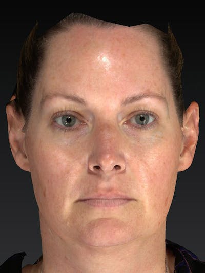 Laser Skin Rejuvenation Before & After Gallery - Patient 114394 - Image 1