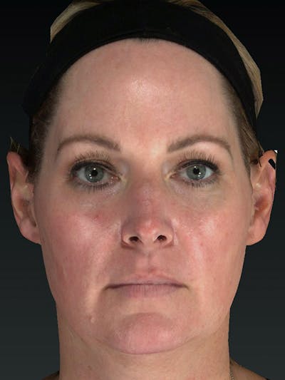 Laser Skin Rejuvenation Before & After Gallery - Patient 114394 - Image 2