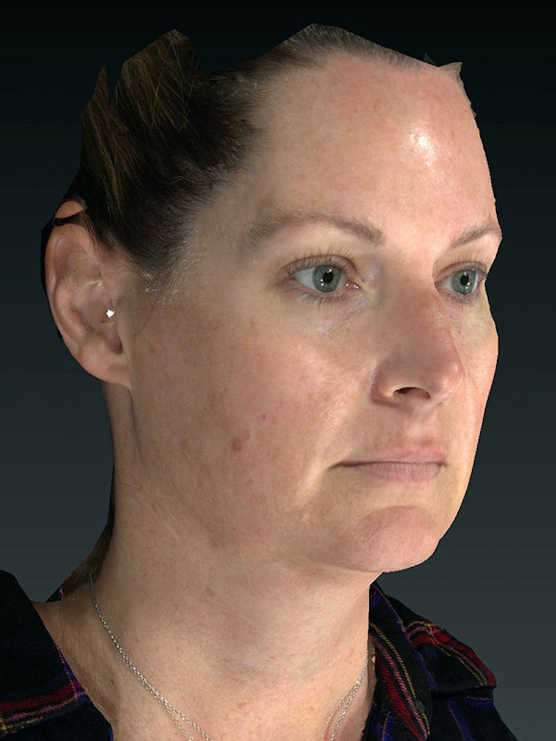 Laser Skin Rejuvenation Before & After Gallery - Patient 114394 - Image 3