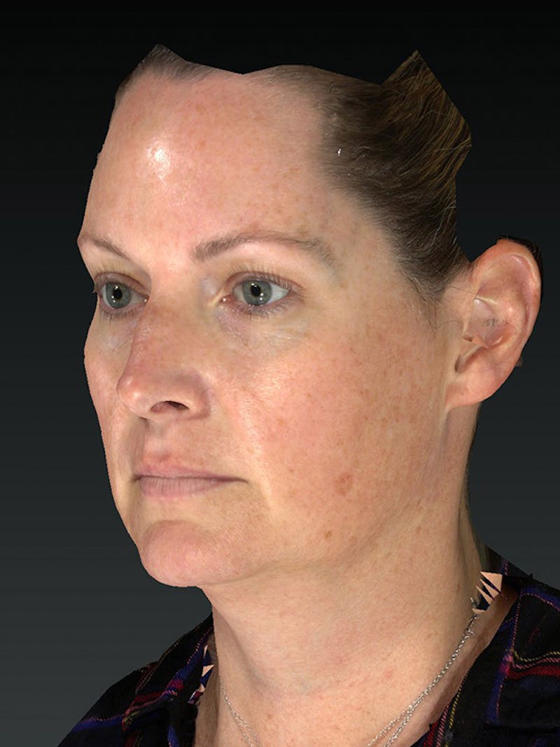 Laser Skin Rejuvenation Before & After Gallery - Patient 114394 - Image 5
