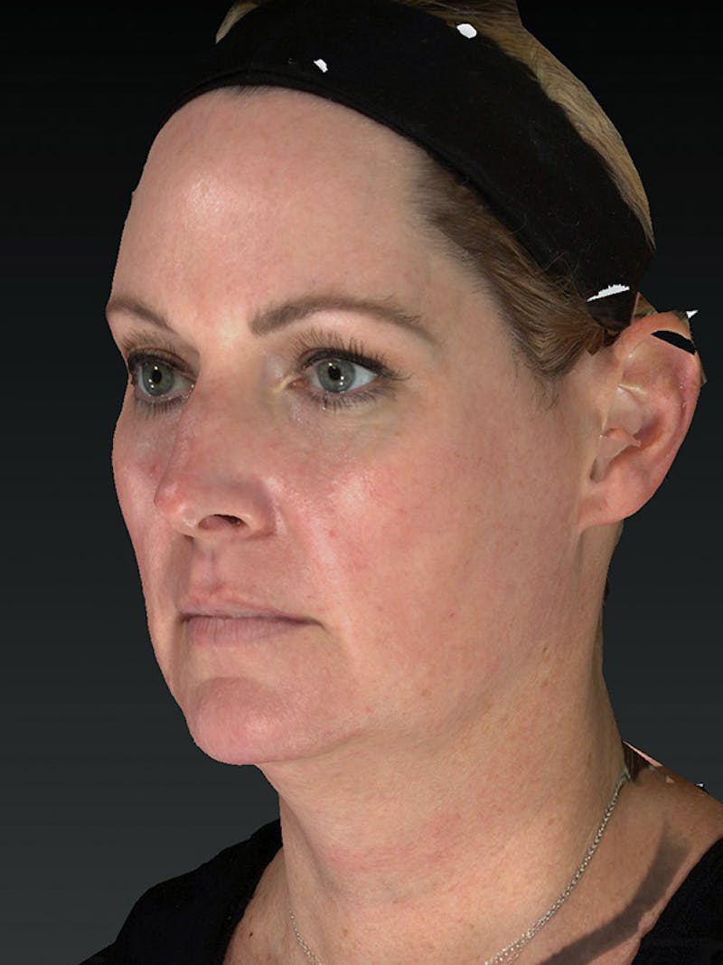Laser Skin Rejuvenation Before & After Gallery - Patient 114394 - Image 6