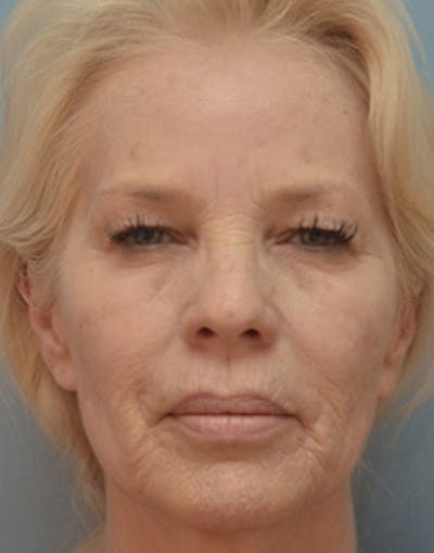 Laser Skin Rejuvenation Before & After Gallery - Patient 313493 - Image 1